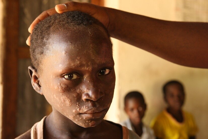 A lepra elleni harc világnapja